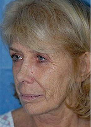 Laser Wrinkle Removal