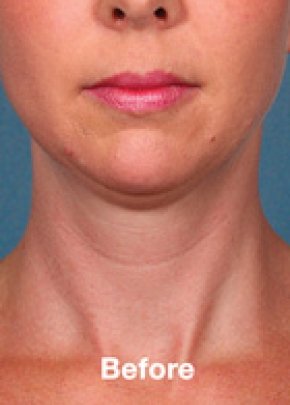 Kybella