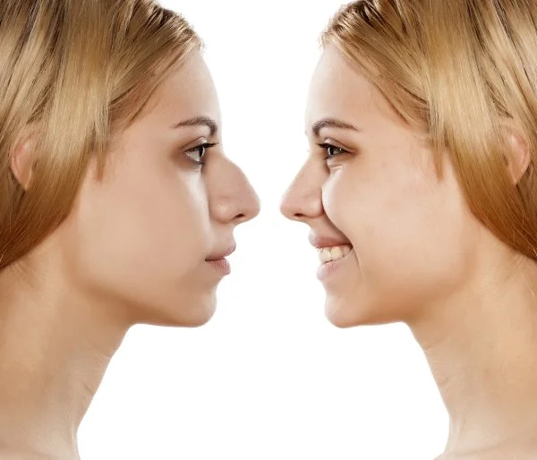 12 Important Topics to Cover at Your Rhinoplasty Surgical Consultation